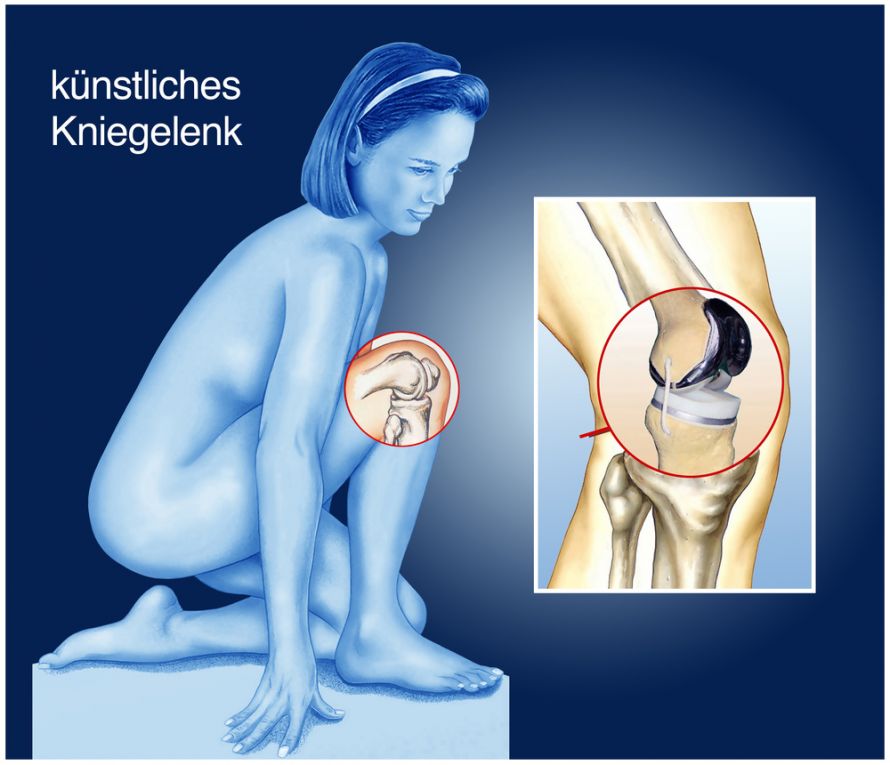 Künstliches Kniegelenk